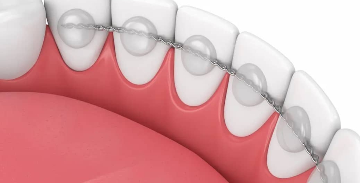Common Problems Fixed by Dental Bonding: Chips, Gaps, and More
