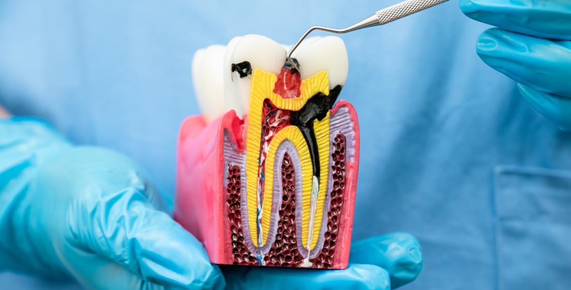 How Can Root Canal Therapy Save Your Tooth from Extraction: A Bedford Guide