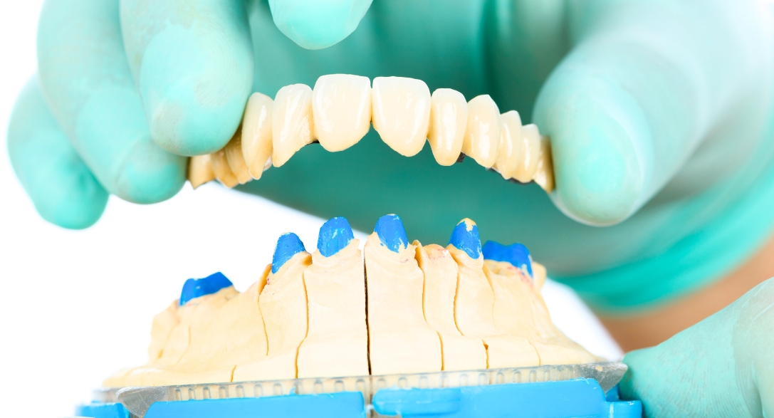 What to Expect During a Dental Bridge Procedure