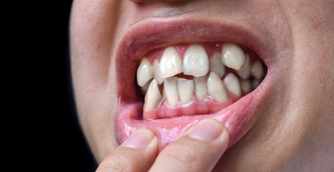 Crooked Teeth? Here’s How Cosmetic Dentistry Can Help